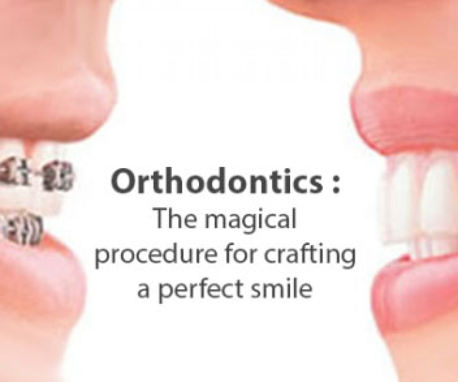 Orthodontics: The magical procedure for crafting a perfect smile!