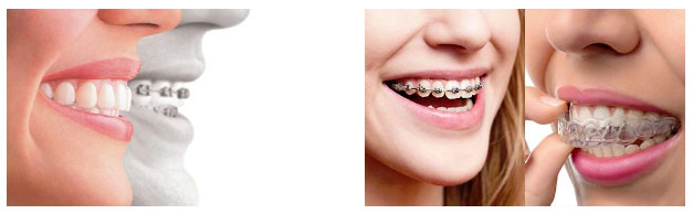Invisible Braces