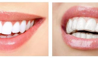 All you need to know about INVISIBLE BRACES